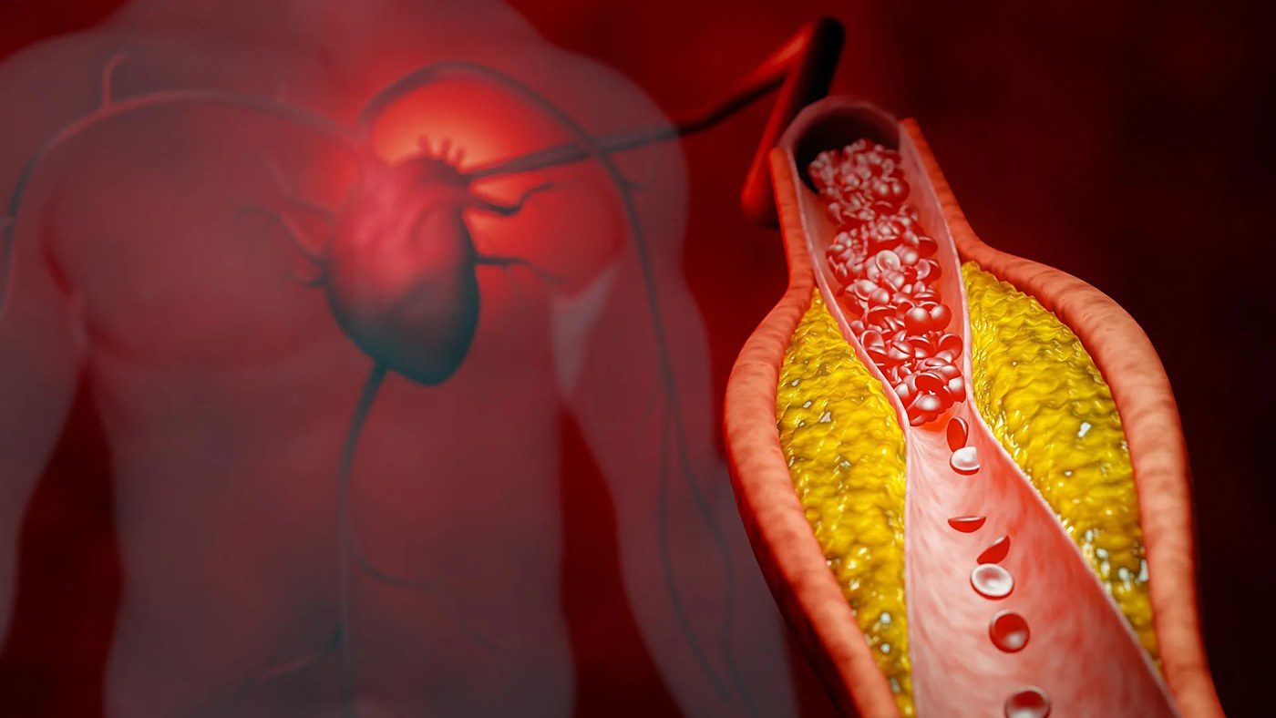 ApoB vs. LDL Cholesterol Testing
